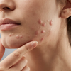 volwassen acne kaaklijn vrouw huidprobleem retinol oplossing